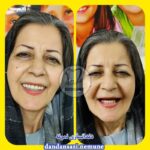 بهترین دندان مصنوعی در ایران 