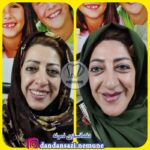 بهترین دندان مصنوعی در ایران 