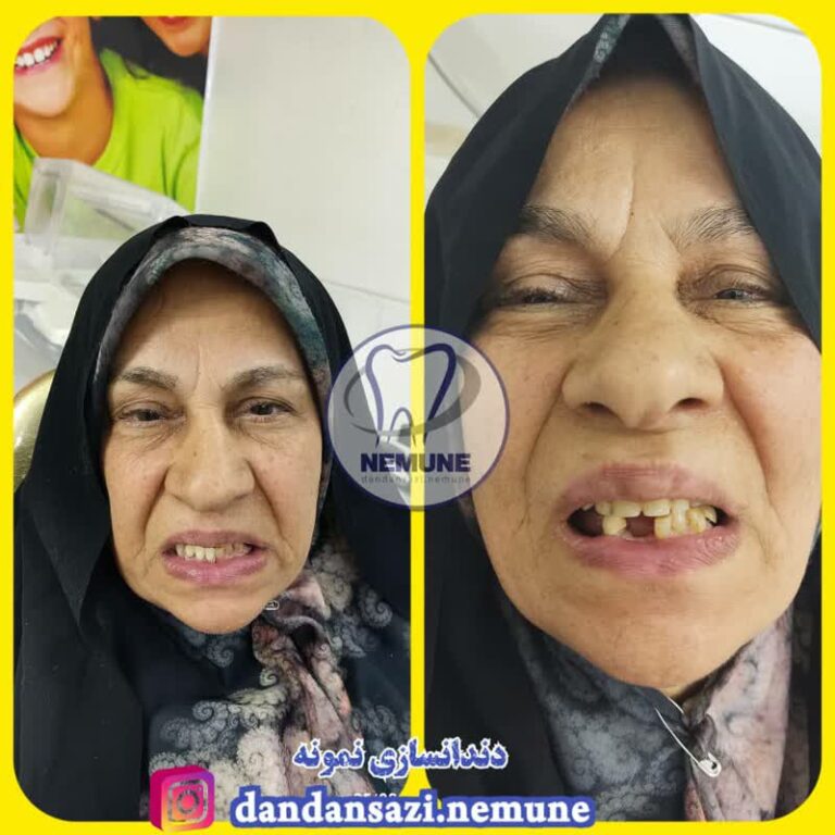 دندانسازی در اصفهان