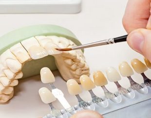 بهترین دندانسازی در کاشان | کلینیک دندانسازی نمونه