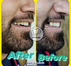 بهترین دندانسازی در نجف آباد | کلینیک دندانسازی نمونه