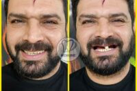 بهترین دندانسازی در شرق تهران | دندانسازی فوری | کلینیک دندانسازی نمونه