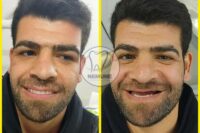 بهترین دندانسازی غرب تهران | کلینیک دندانسازی نمونه